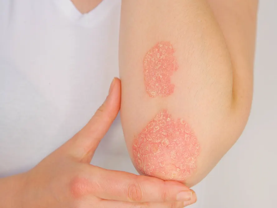 Stock photograph of a model: a person's inner elbow with two red, scaly patches, steadied by their other hand