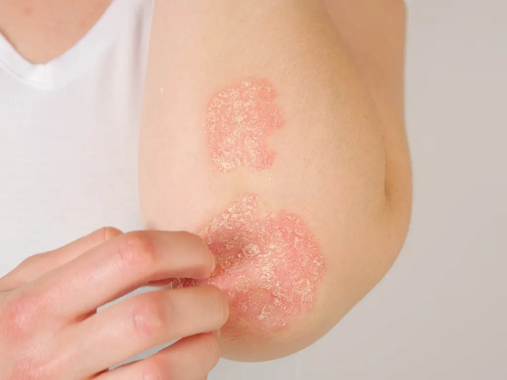 Stock photograph of a model: a hand touches red, scaly patches of skin on an elbow