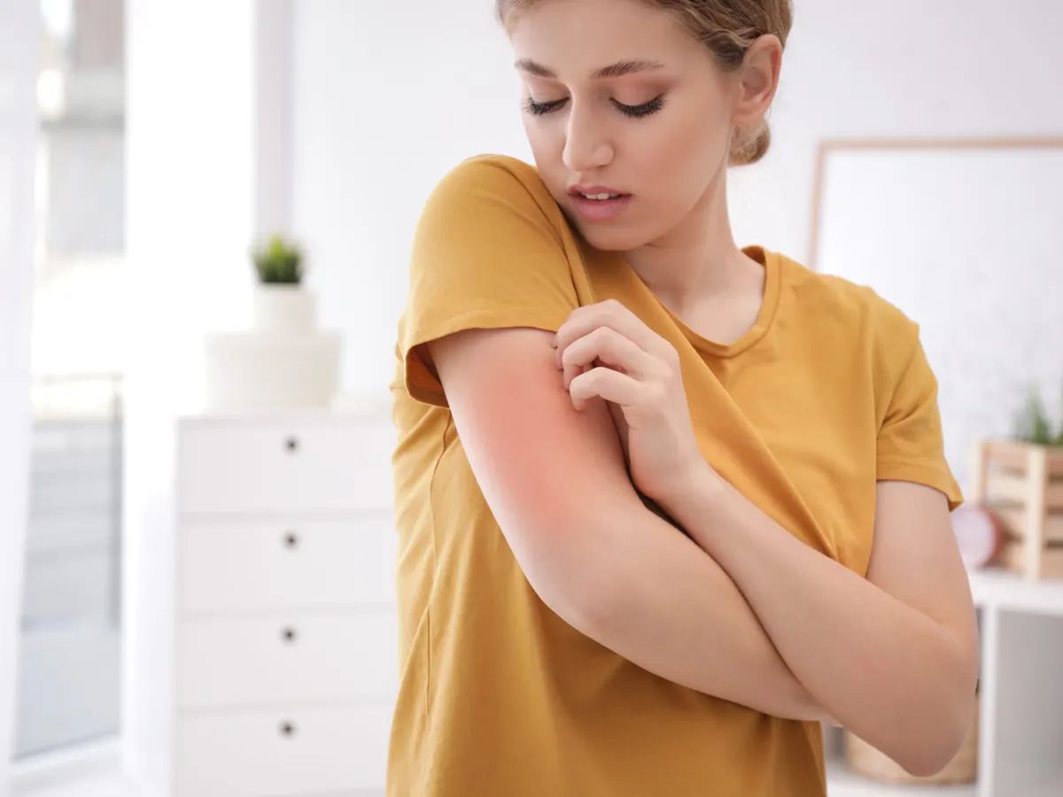Stock photograph of a model: a woman in a mustard t-shirt scratches a reddened patch on her upper arm