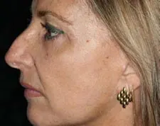 After ActiveFX treatment: a woman's face in profile, showing the cheek and jawline, with a gold earring