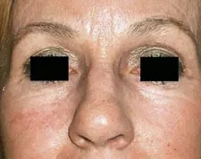 After ActiveFX treatment: a woman's nose and cheeks with the eyes masked by black bars