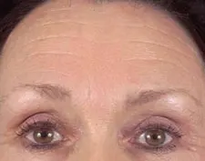After ActiveFX treatment: a woman's forehead and eyes looking at the camera, with smoother forehead skin