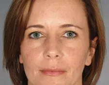 After ActiveFX treatment: a woman's face, front view, looking at the camera, with even skin tone