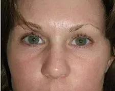 After ActiveFX treatment: a woman's eyes and nose, front view, with green eyes and smoother under-eye skin