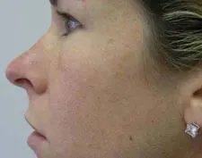 After ActiveFX treatment: a woman's face in profile showing nose and cheek, with a stud earring