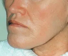 After ActiveFX treatment: a woman's lower face, lips and jawline in close-up, with smoother skin