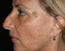 Before ActiveFX treatment: a woman's face in profile showing brown sun spots on the cheek and temple