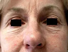 Before ActiveFX treatment: an older woman's nose and cheeks with the eyes masked by black bars, with fine lines and creases