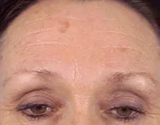 Before ActiveFX treatment: a woman's forehead and eyes with horizontal lines and a small brown spot on the forehead