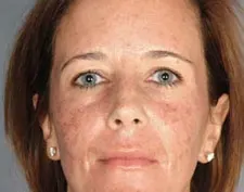 Before ActiveFX treatment: a woman's face, front view, with freckled, uneven pigmentation on the cheeks