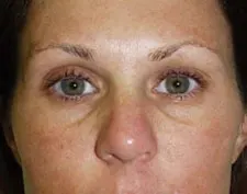 Before ActiveFX treatment: a woman's eyes and nose, front view, with green eyes and darker under-eye shadows