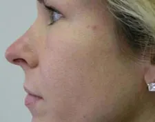 Before ActiveFX treatment: a woman's face in profile showing nose and cheek, with a stud earring