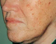 Before ActiveFX treatment: a woman's lower face, lips and jawline in close-up, with scattered brown spots
