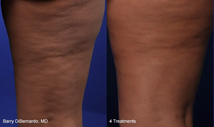 Before and after Thermismooth treatment: back of a woman's thighs, with less visible cellulite dimpling after 4 treatments; captions 'Barry DiBernardo, MD' and '4 Treatments'