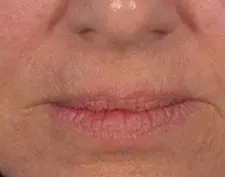 After Deep FX treatment: a close-up of the nose and lips with smoother skin around the mouth