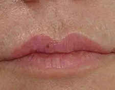 After Deep FX treatment: a close-up of the upper lip with a small mole, with smoother lip skin
