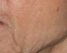 After Deep FX treatment: a close-up of a cheek and nasolabial fold with smoother skin