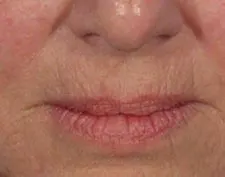 Before Deep FX treatment: a close-up of the nose and lips with fine lines around the mouth