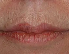 Before Deep FX treatment: a close-up of the upper lip with a small mole and fine vertical lines