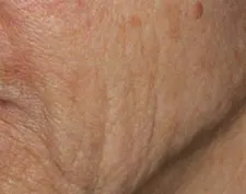 Before Deep FX treatment: a close-up of a cheek and nasolabial fold with visible creases