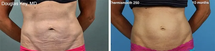 Before and after Thermismooth 250 treatment: a woman's abdomen with looser, crepey skin before and tighter skin 10 months later; captions 'Douglas Key, MD' and '10 months'