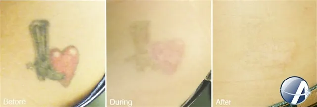 Before, during and after laser tattoo removal: a heart-and-gun tattoo on the skin fading through treatment to nearly clear skin