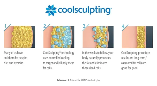 CoolSculpting logo and four-step diagram of how the treatment works: controlled cooling targets fat cells, the body clears them, and results are long-term