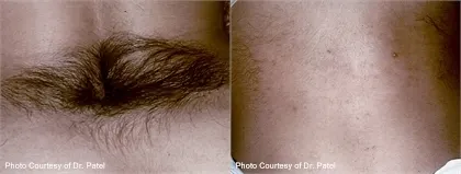 Before and after laser hair removal: a patch of dark hair on the lower back, and the same area with hair removed; captions 'Photo Courtesy of Dr. Patel'
