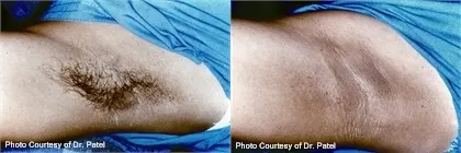 Before and after laser hair removal: dark underarm hair, and the same underarm smooth and hair-free; captions 'Photo Courtesy of Dr. Patel'