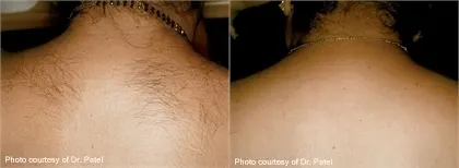 Before and after laser hair removal: dark hair across the upper back and neck, and the same area with hair removed; captions 'Photo courtesy of Dr. Patel'