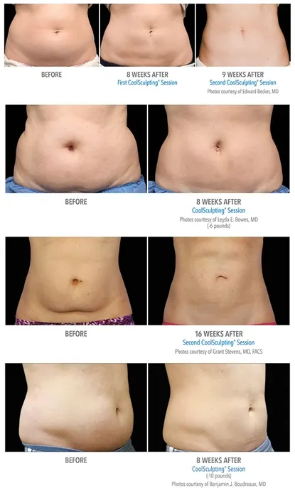 Before and after CoolSculpting collage of four abdomens, labeled 8 weeks, 9 weeks and 16 weeks after one or two sessions, with photo credits to treating physicians