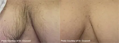 Before and after laser hair removal: an underarm, with visibly less hair in the after photograph; both photographs read "Photo Courtesy of Dr. Councell"