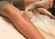 A gloved hand holds a laser handpiece with a red light against a person's knee during a laser hair removal treatment