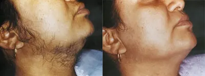Before and after laser hair removal: a person's chin and neck, with visibly less facial hair in the after photograph on the right