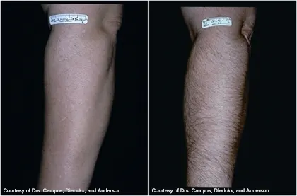 Before and after laser hair removal: a lower leg shown smooth in the left photograph and hairy in the right; credit "Courtesy of Drs. Campos, Dierickx, and Anderson"