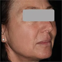 After a Photofractional treatment: a woman's face in three-quarter view, with her eyes covered by a grey bar