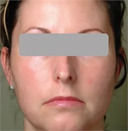 After a Photofractional treatment: front view of a woman's face with her eyes covered by a grey bar