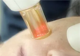 A handpiece with a glowing red-orange light pressed against a forehead during a Photofractional treatment