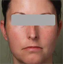 Before a Photofractional treatment: front view of a woman's face with her eyes covered by a grey bar