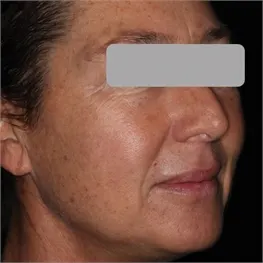 Before a Photofractional treatment: a woman's face in three-quarter view, with her eyes covered by a grey bar