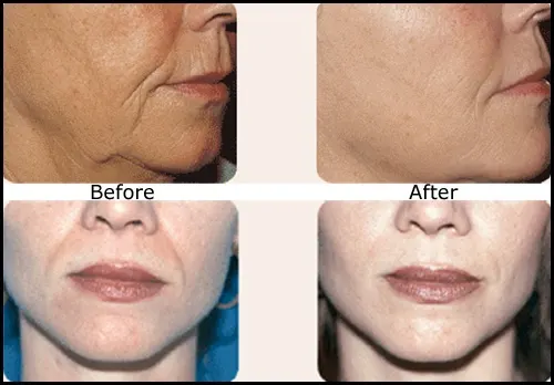 Before and after Sculptra: a woman's cheek in profile above a front view of her lower face, with lines softer in the After photographs