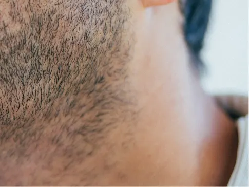 Stock photograph of a model: a man's chin with a beard that has one small bare round patch