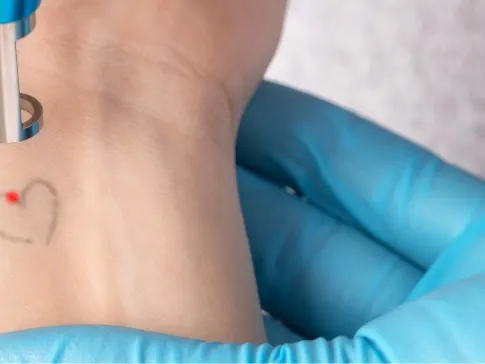 Stock photograph: a blue-gloved hand holds a laser handpiece with a red light over a faded small heart tattoo on a wrist
