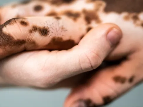 Stock photograph of models: two hands clasped, one with patchy light and dark areas of skin pigmentation