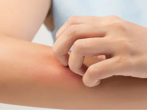 Stock photograph of a model: a person scratches a reddened patch on their forearm