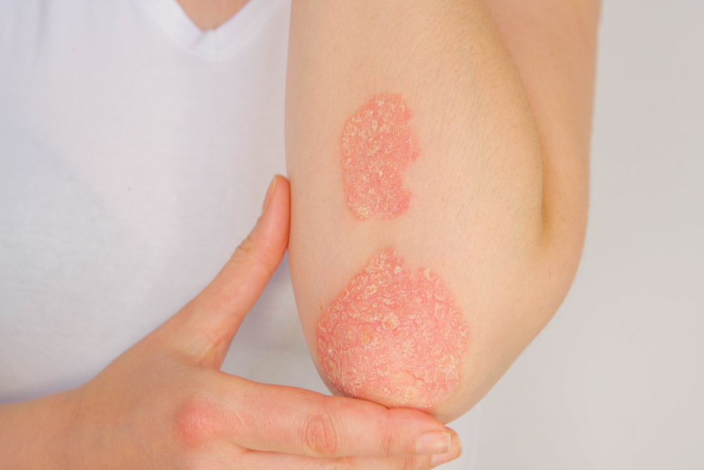 Stock photograph of a model: a person's inner elbow with two red, scaly patches, steadied by their other hand