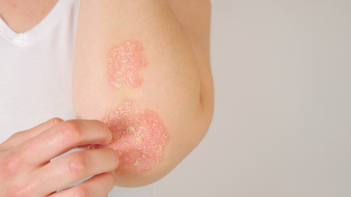 Stock photograph of a model: a hand touches red, scaly patches of skin on an elbow