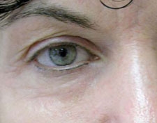After ActiveFX treatment: a close-up of one eye and brow with smoother skin around the eyelid and under-eye area