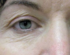 Before ActiveFX treatment: a close-up of one eye and brow with fine lines and creases around the eyelid and under-eye area