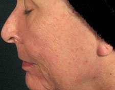 After Deep FX treatment: a woman's profile and cheek in close-up with finer, less pronounced wrinkles